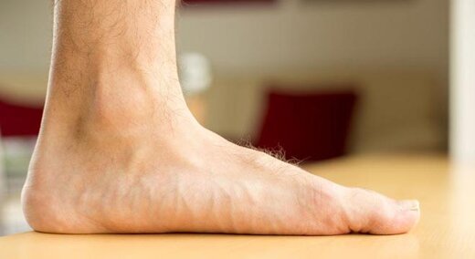 کف پاي صاف چيست؟/ بهترين روش درمان خانگي کف پاي صاف